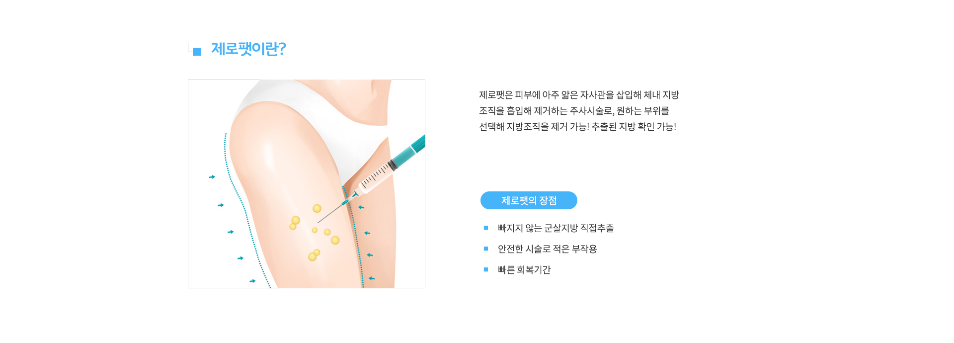 제로팻이란? 제로팻은 피부에 아주 얇은 자사관을 삽입해 체내 지방 조직을 흡입해 제거하는 주사시술로, 원하는 부위를 선택해 지방조직을 제거 가능! 추출된 지방 확인 가능! / 제로팻의 장점은 첫번째, 빠지지 않는 군살지방 직접추출. 두번째,  안전한 시술로 적은 부작용. 세번째, 빠른 회복기간