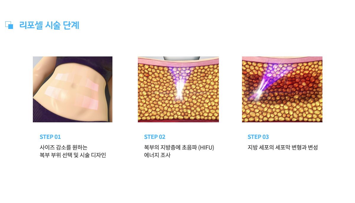 리포셀 시술 단계,
					1. 사이즈 감소를 원하는 복부 부위 선택 및 시술 디자인,
					2. 복부의 지방층에 초음파(HIFU) 에너지 조사,
					3. 지방 세포의 세포막 변형과 변성