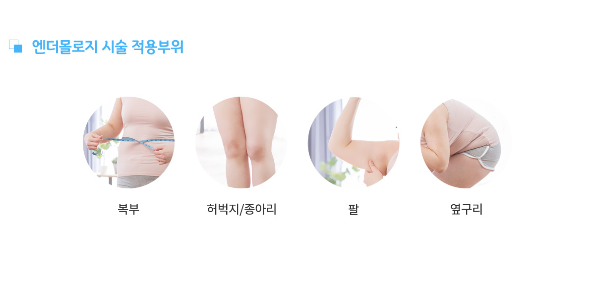 엔더몰로지 시술 적용부위, 복부, 허벅지/종아리, 팔, 옆구리